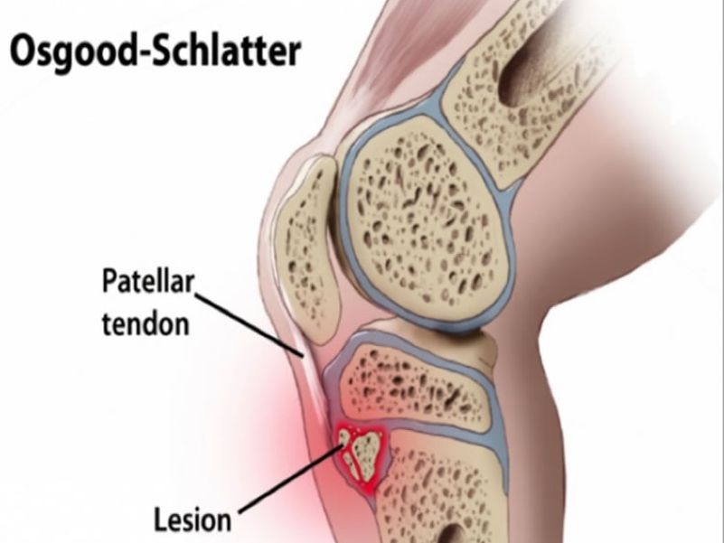 Osgood-Schlatter